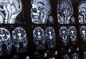 san-diego-brain-injury-attorney